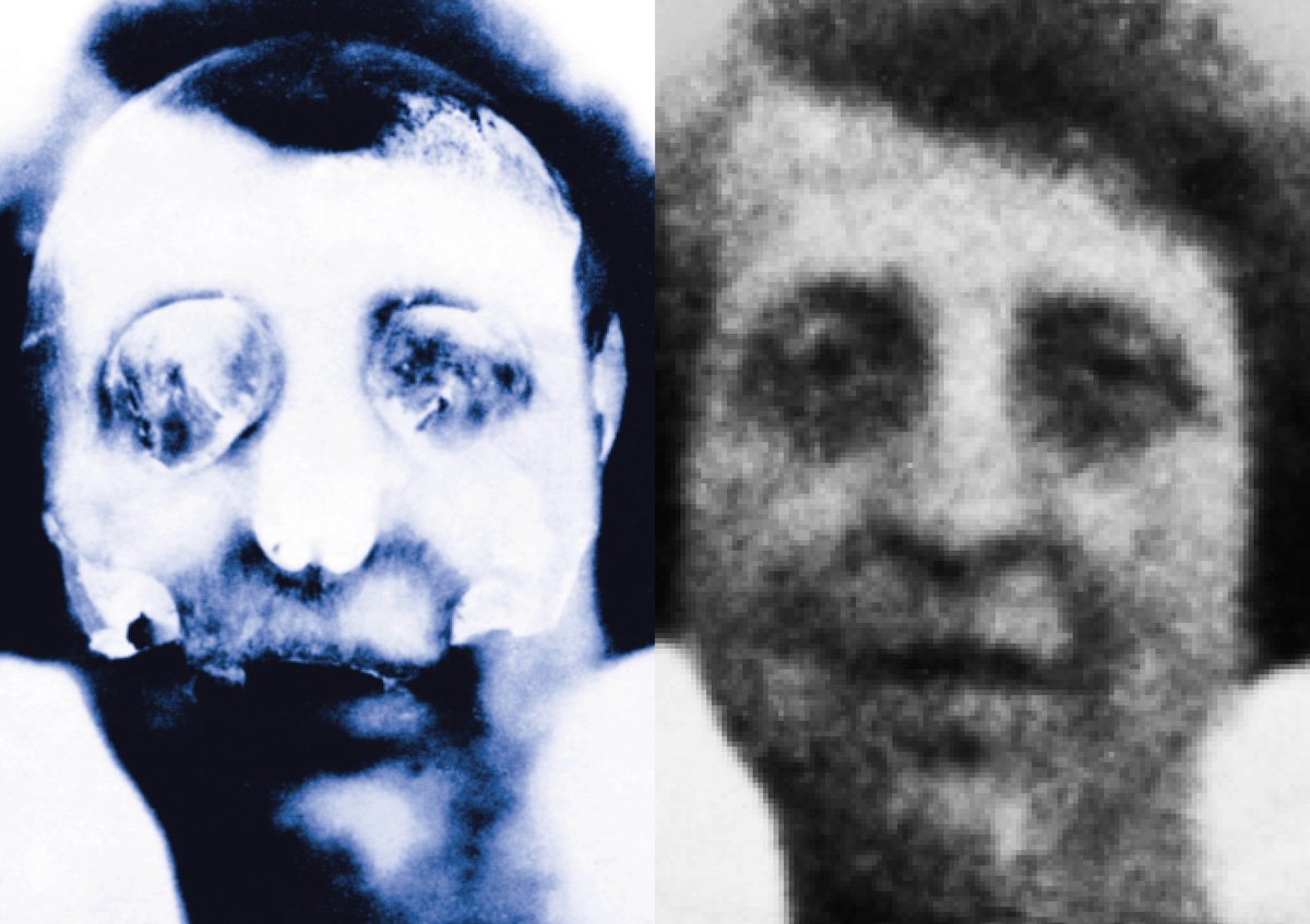 The superimposed image of Rachel Dobkin produced by Mary Newman, Guy’s Hospital, 1942. TopFoto/Mirrorpix. The superimposed image of Rachel Dobkin produced by Mary Newman, Guy’s Hospital, 1942. TopFoto/Mirrorpix.